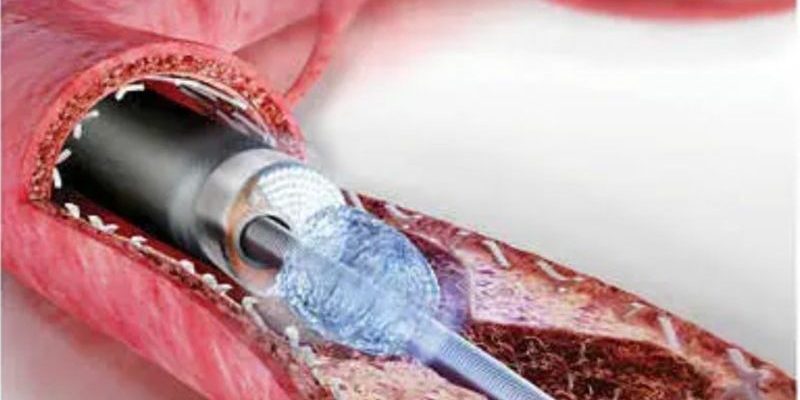 Laser intra-coronarico per PTCA complesse: primo caso al Fatebenefratelli